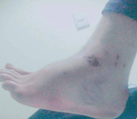 صور أخرى توضح إصابة المعتقل "أحمد جمعة"